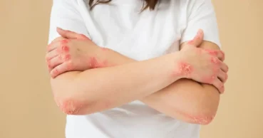 Dermatite: Causas, Prevenção e Tratamentos Essenciais para a Saúde da Pele