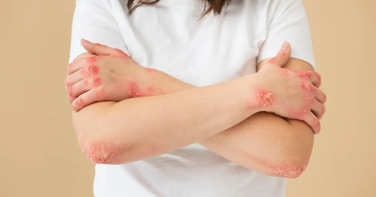 Dermatite: Causas, Prevenção e Tratamentos Essenciais para a Saúde da Pele